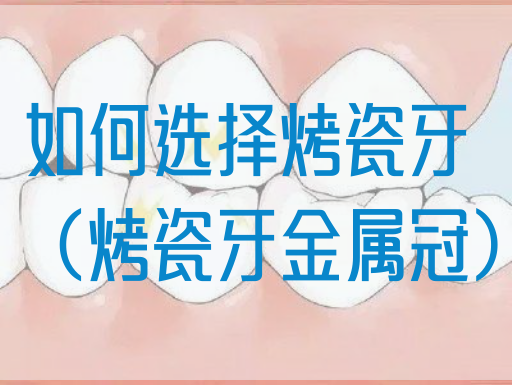 如何选择烤瓷牙（烤瓷牙金属冠）