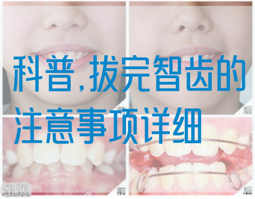 科普,拔完智齿的注意事项详细