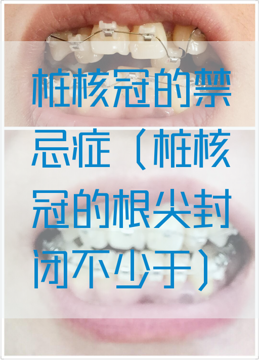 桩核冠的禁忌症（桩核冠的根尖封闭不少于）