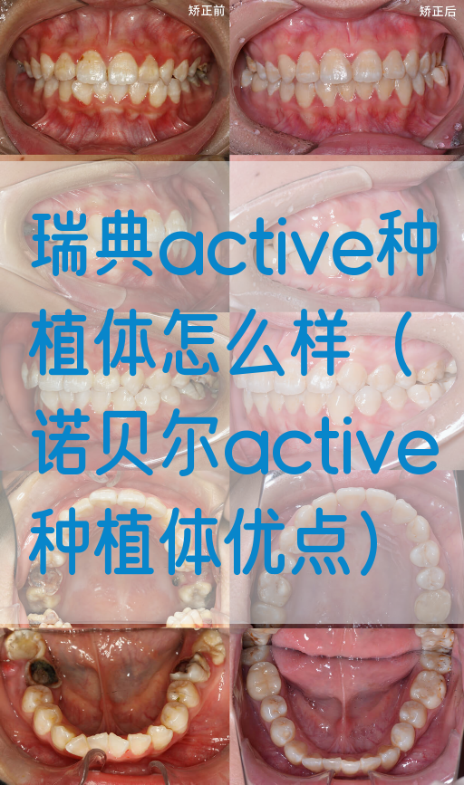 瑞典active种植体怎么样（诺贝尔active种植体优点）