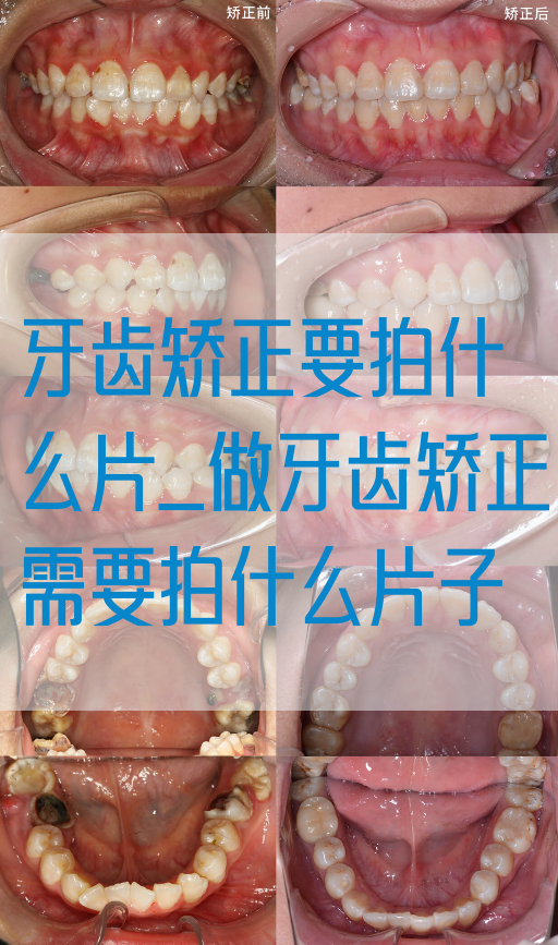 牙齿矫正要拍什么片_做牙齿矫正需要拍什么片子(图1)