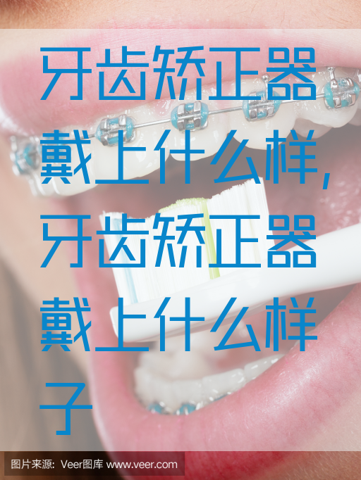 牙齿矫正器戴上什么样,牙齿矫正器戴上什么样子