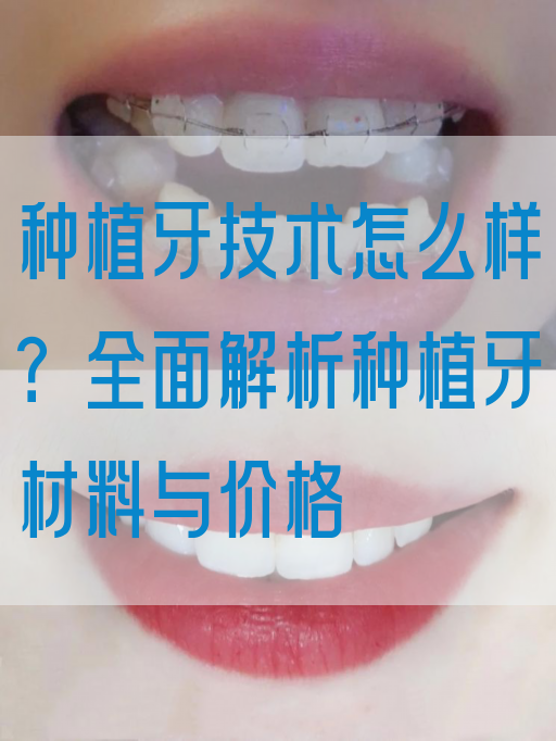 种植牙技术怎么样？全面解析种植牙材料与价格