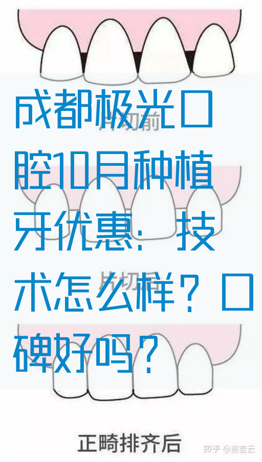 成都极光口腔10月种植牙优惠：技术怎么样？口碑好吗？