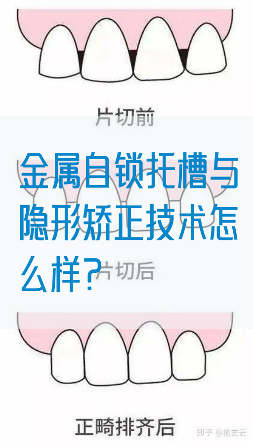 金属自锁托槽与隐形矫正技术怎么样？