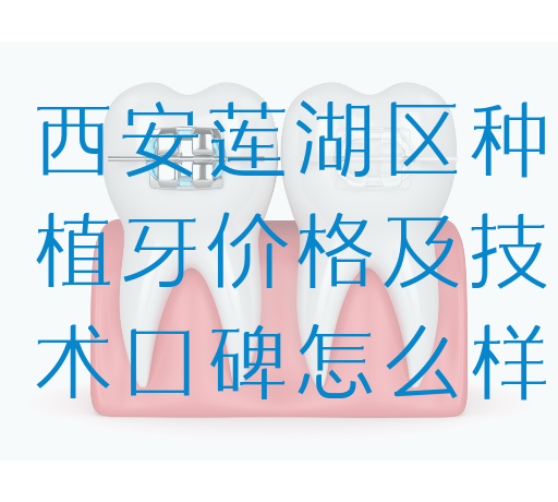 西安莲湖区种植牙价格及技术口碑怎么样