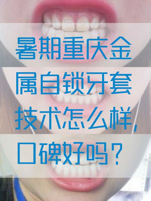 暑期重庆金属自锁牙套技术怎么样，口碑好吗？