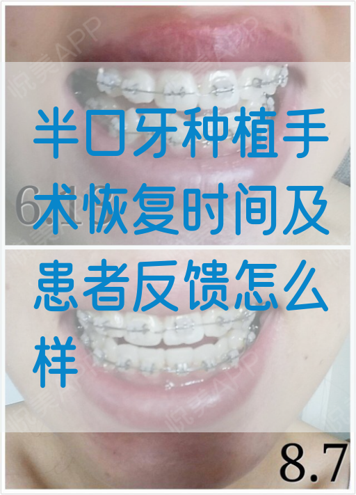 半口牙种植手术恢复时间及患者反馈怎么样