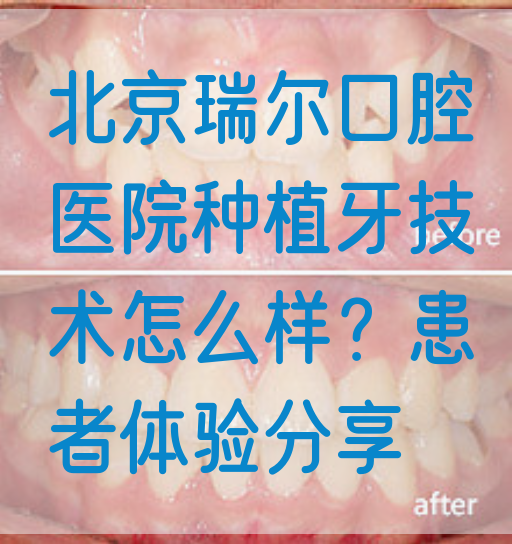 北京瑞尔口腔医院种植牙技术怎么样？患者体验分享