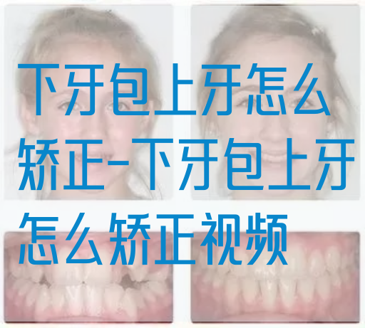 下牙包上牙怎么矫正-下牙包上牙怎么矫正视频