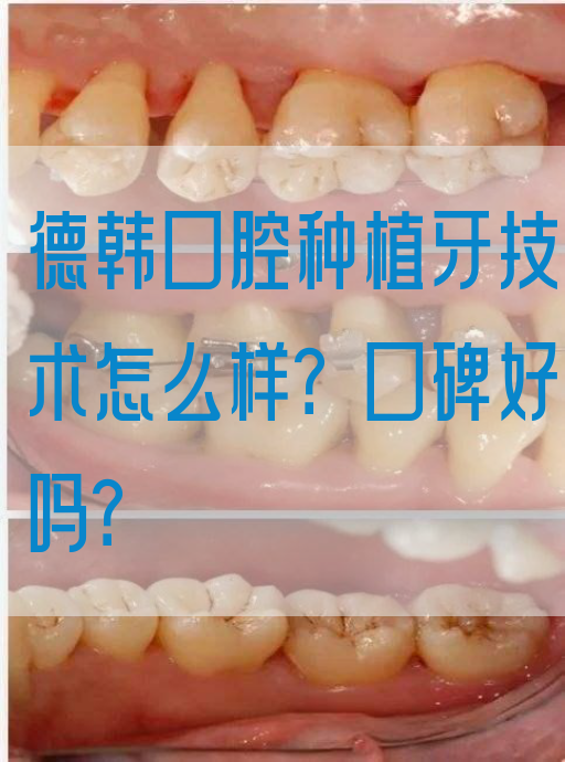 德韩口腔种植牙技术怎么样？口碑好吗？