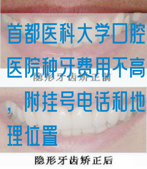 首都医科大学口腔医院种牙费用不高，附挂号电话和地理位置