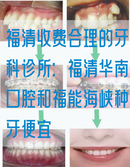 福清收费合理的牙科诊所：福清华南口腔和福能海峡种牙便宜