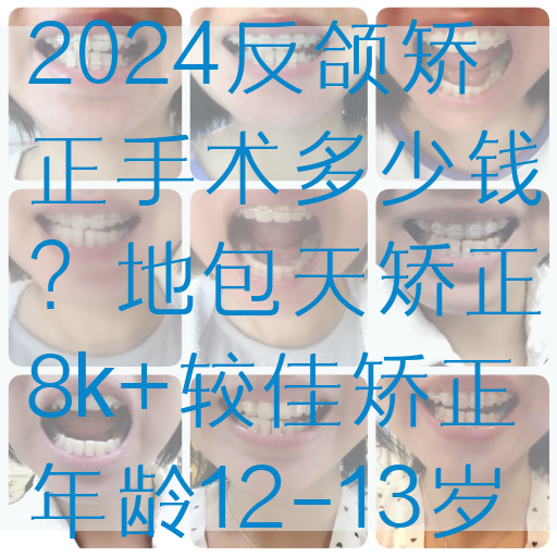 2024反颌矫正手术多少钱？地包天矫正8k+较佳矫正年龄12-13岁