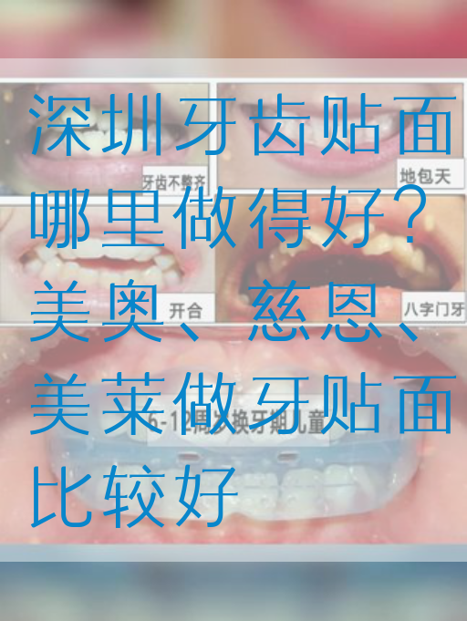 深圳牙齿贴面哪里做得好？美奥、慈恩、美莱做牙贴面比较好