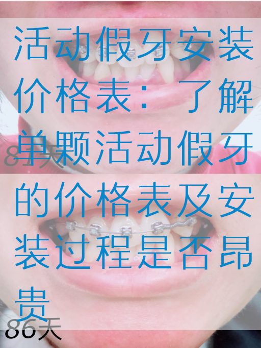 活动假牙安装价格表：了解单颗活动假牙的价格表及安装过程是否昂贵