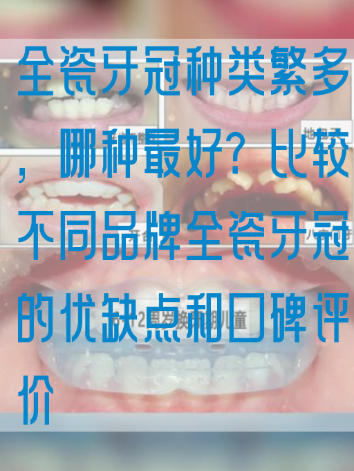 全瓷牙冠种类繁多，哪种最好？比较不同品牌全瓷牙冠的优缺点和口碑评价