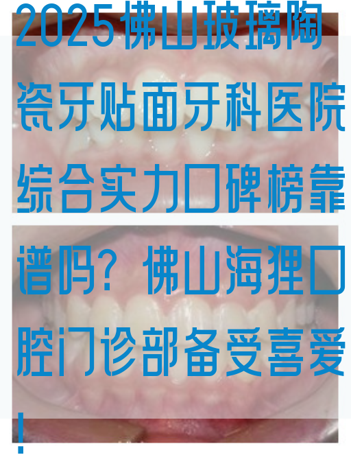 2025佛山玻璃陶瓷牙贴面牙科医院综合实力口碑榜靠谱吗？佛山海狸口腔门诊部备受喜爱！