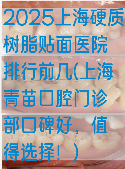2025上海硬质树脂贴面医院排行前几(上海青苗口腔门诊部口碑好，值得选择！)