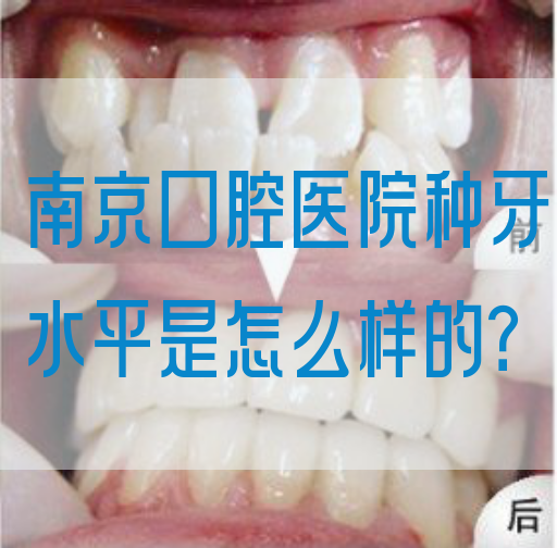 南京口腔医院种牙水平是怎么样的？