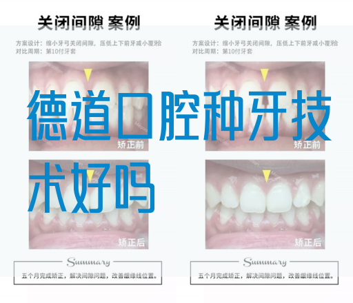 德道口腔种牙技术好吗