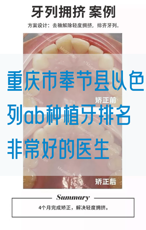 重庆市奉节县以色列ab种植牙排名非常好的医生