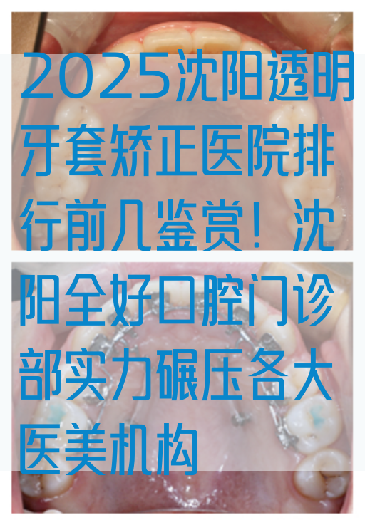 2025沈阳透明牙套矫正医院排行前几鉴赏！沈阳全好口腔门诊部实力碾压各大医美机构