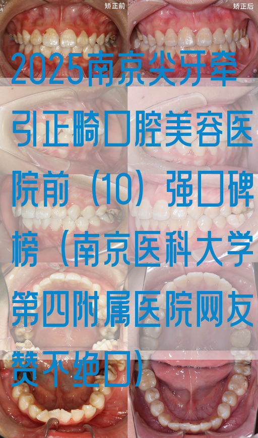 2025南京尖牙*正畸口腔美容医院前(10)强口碑榜(南京医科大学第四附属医院网友赞不绝口)