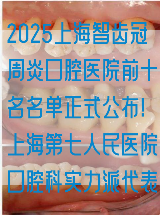 2025上海智齿冠周炎口腔医院前十名名单正式公布！上海第七人民医院口腔科实力派代表