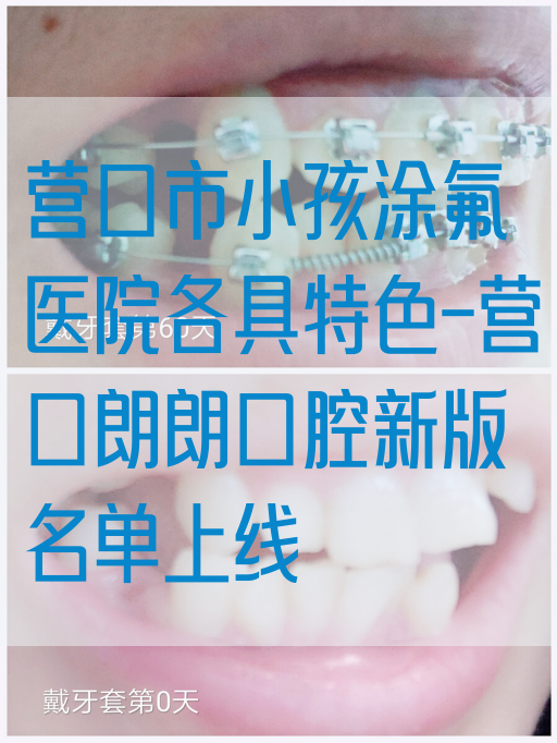 营口市小孩涂氟医院各具特色-营口朗朗口腔新版名单上线