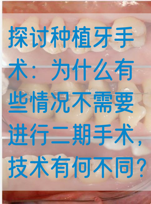 探讨种植牙手术：为什么有些情况不需要进行二期手术，技术有何不同？