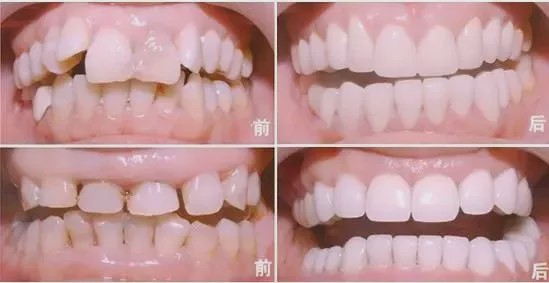 四环素牙怎样才能变白？四环素牙做贴面、冷光美白都可遮色(图1)