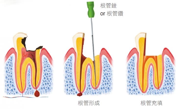 根管治疗450块钱三次贵吗？不贵，若是显微治疗至少800+(图3)