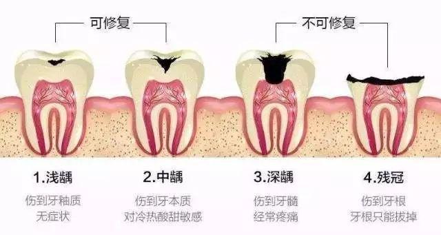 科普、牙齿矫正过程，你需要*历这11个阶段(图2)