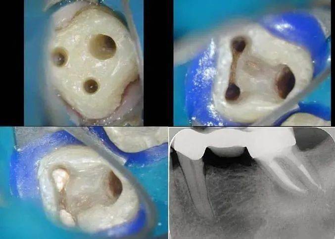 门牙做牙冠好还是贴面好？怎么有人说做牙齿贴面牙就报废啦(图3)