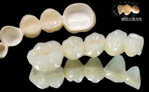 纯钛牙冠和全瓷牙冠哪个贵？全瓷牙冠集采后656元起、美观性好(图1)