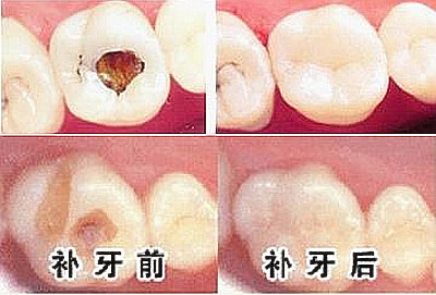 西安弗莱堡口腔低价不是*人的，弗莱堡口腔种植牙团购价1580(图1)