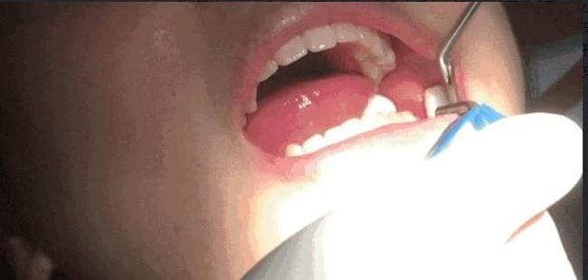 我拔掉了*常发炎的智齿，虽然不痛但是*肿得非常厉害(图1)