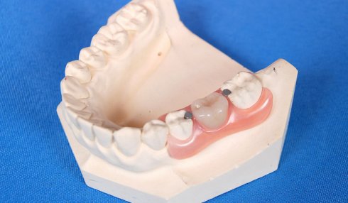 换活动假牙用树脂托好还是纯钛托好？纯钛支架好，不易变形(图2)