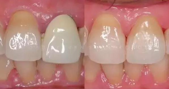 二氧化锆全瓷牙价格一览：国产与进口费用对比，是否值得投资？(图1)