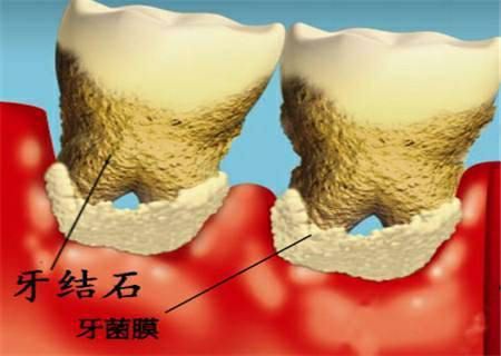 牙贴面费用多少？了解牙贴面的价格表一览，及技术对牙齿健康的影响(图1)