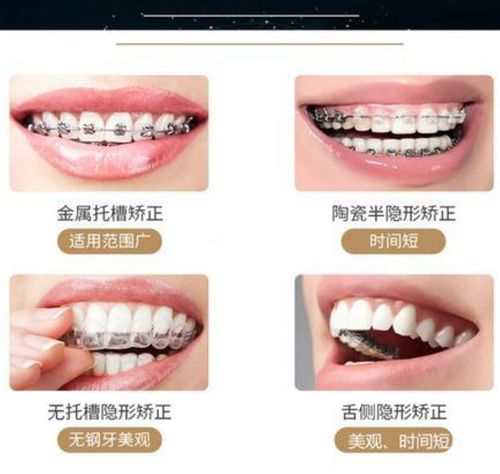 牙齿矫正后不戴保持器的严重后果：多少钱的矫正费用可能付诸东流？(图1)
