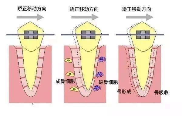 整牙过程中更换钢丝的次数和费用问题，技术怎么样，换一次钢丝多少钱，口碑怎么样(图1)