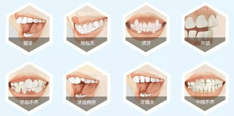 深覆合牙齿矫正效果怎么样？看看一度二度三度的区别和矫正前后对比(图1)