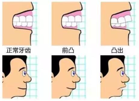 成年人整牙效果怎么样？看看我戴牙套一年后的*型变化，技术好吗？(图1)