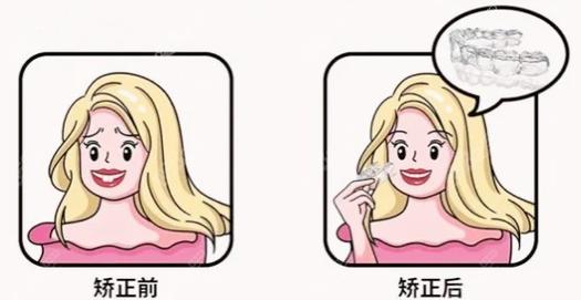 隐形牙套矫正费用多少？了解价格表和矫正效果，是否值得投资？(图1)