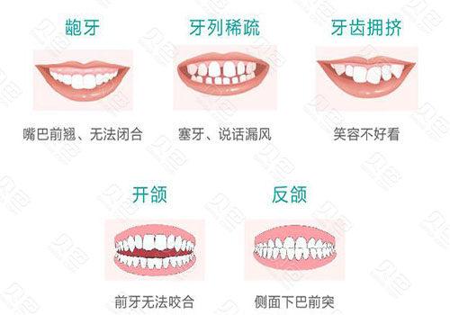 长期缺牙后牙齿矫正是否可行？假牙矫正技术怎么样？口碑评价如何？(图1)