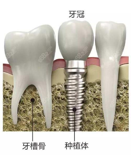 东莞健力口腔医院收费一览：种植牙、正畸等口腔服务价格表及价格表(图1)