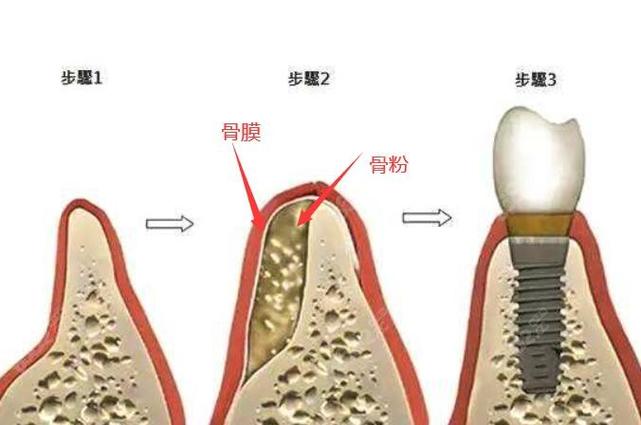瑞士士卓曼种植牙真假识别指南及各型号价格价格表表，是否值得高价投资？(图1)