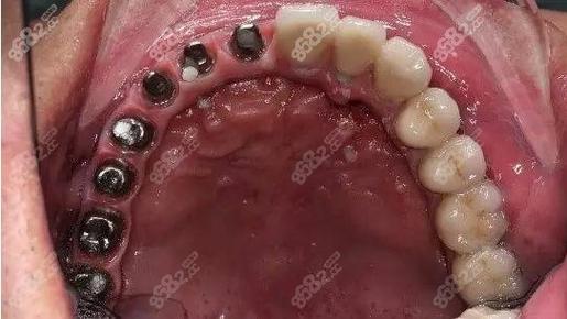 沃兰种植牙效果如何？了解其优缺点及使用寿命，选择适合自己的种植牙技术(图1)